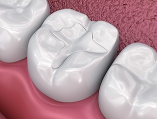 A 3D illustration of tooth-colored fillings