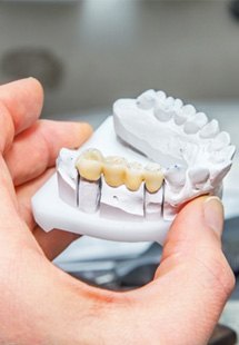 Dental bridge on a clay model