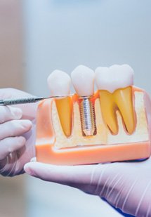 Dentist pointing to a dental implant model