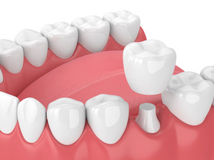 Illustration of a dental crown being placed on a tooth